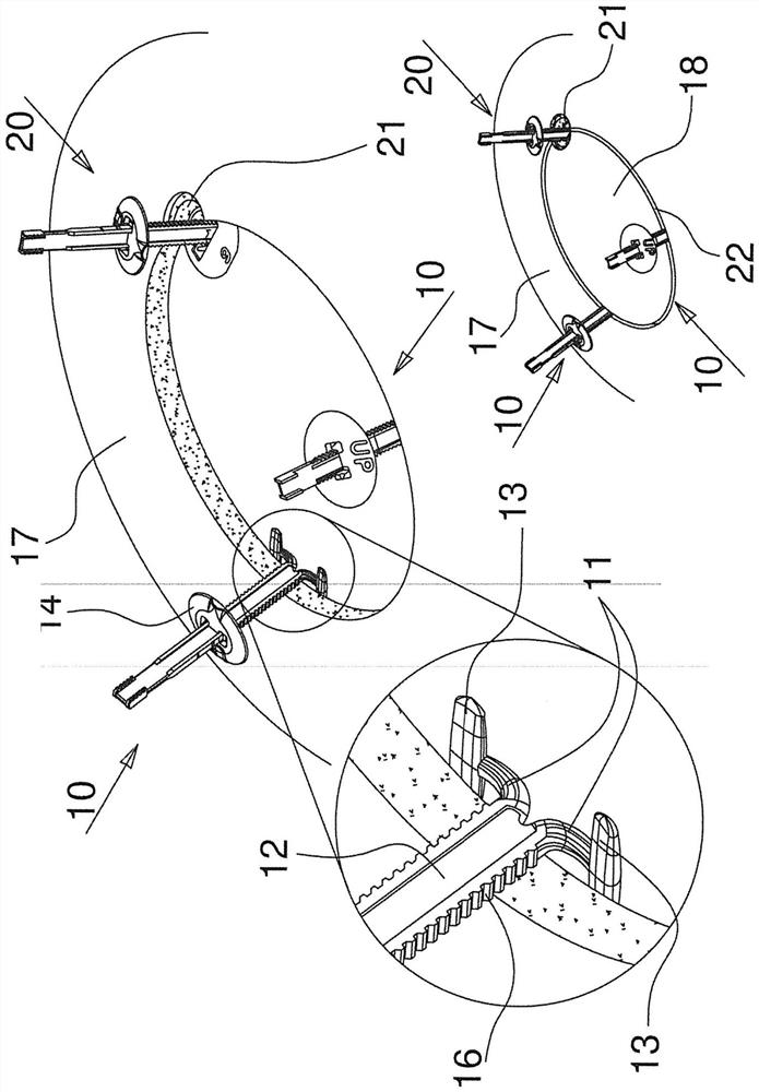 Device for fixing a craniotomy operculum to the cranial vault to be inserted in the craniotomy cut