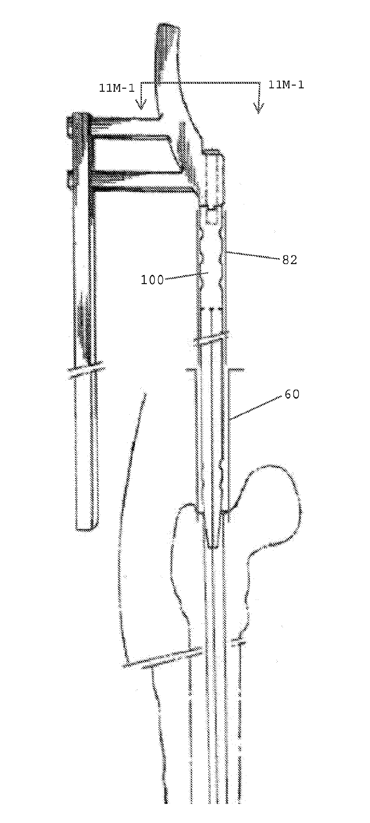 Minimally invasive endoscopic systems for placing intramedullary nails and methods therefor