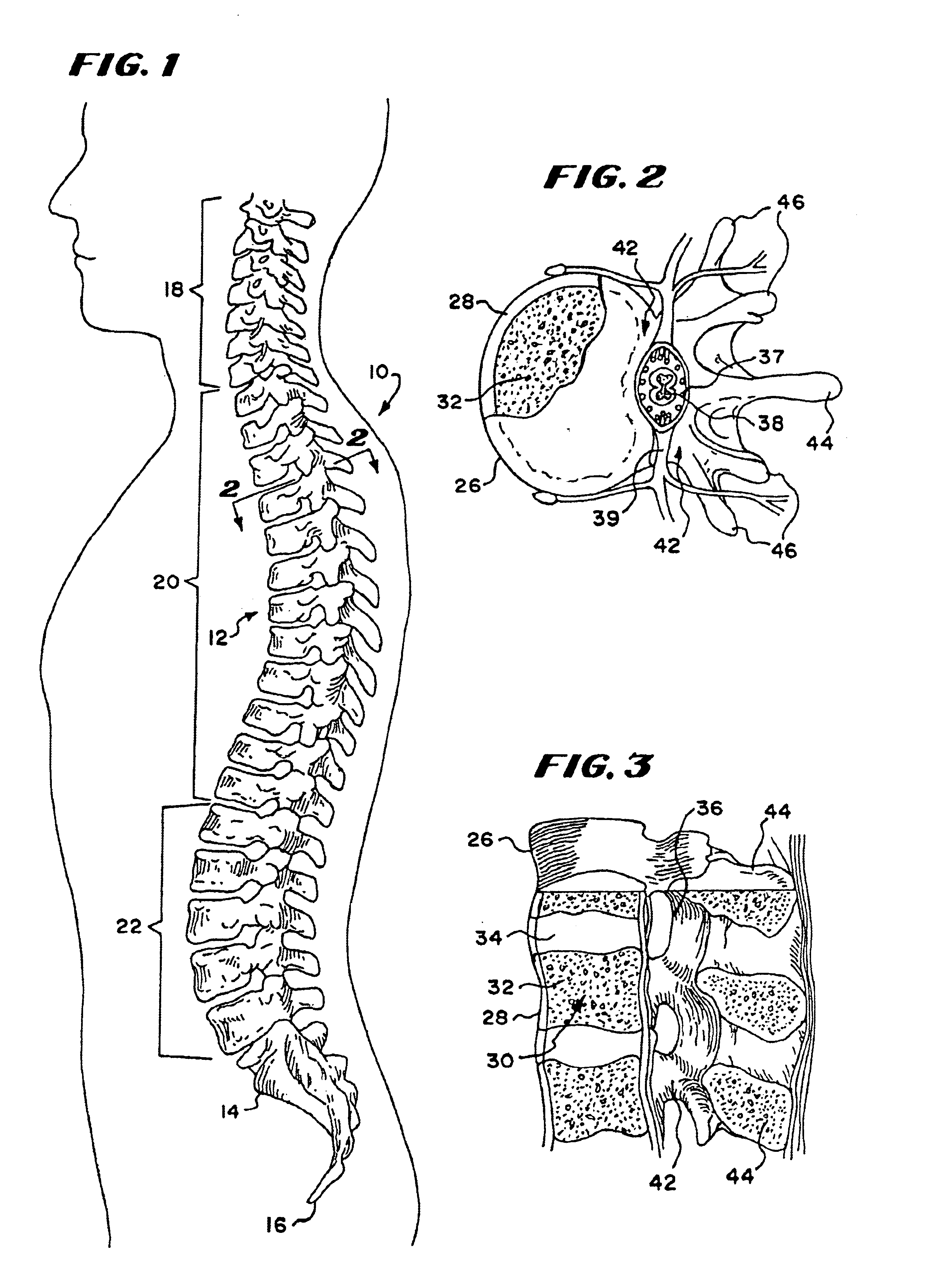 Systems and methods for treating fractured or diseased bone using expandable bodies