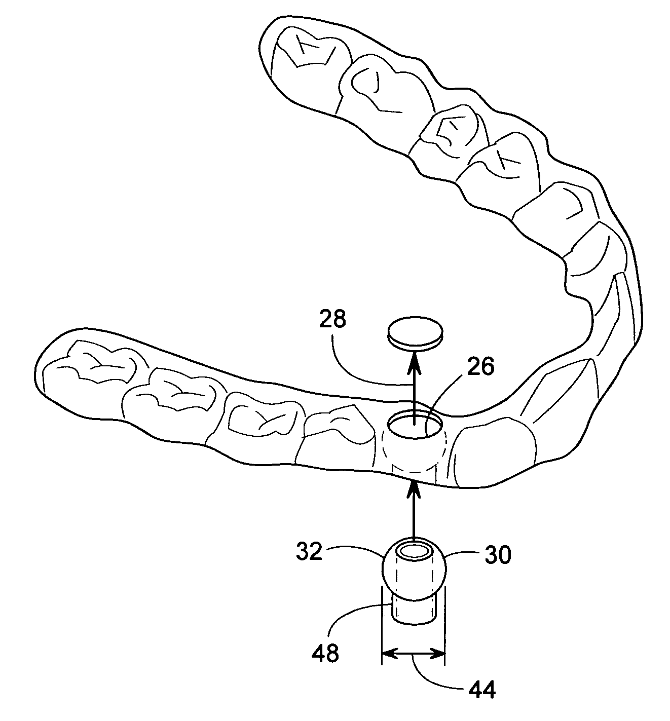 Spherical drill bushing for installing a dental implant