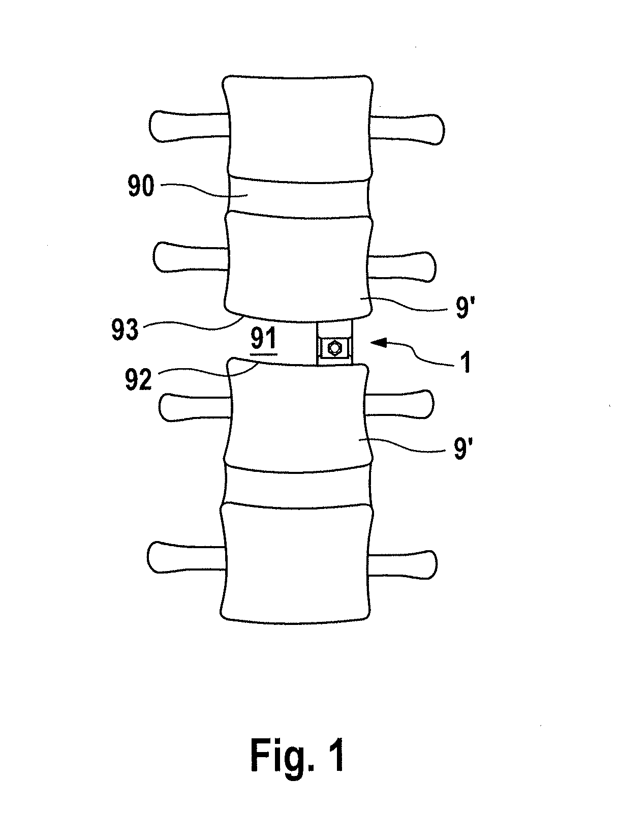 Continuously height-adjustable intervertebral fusion implant
