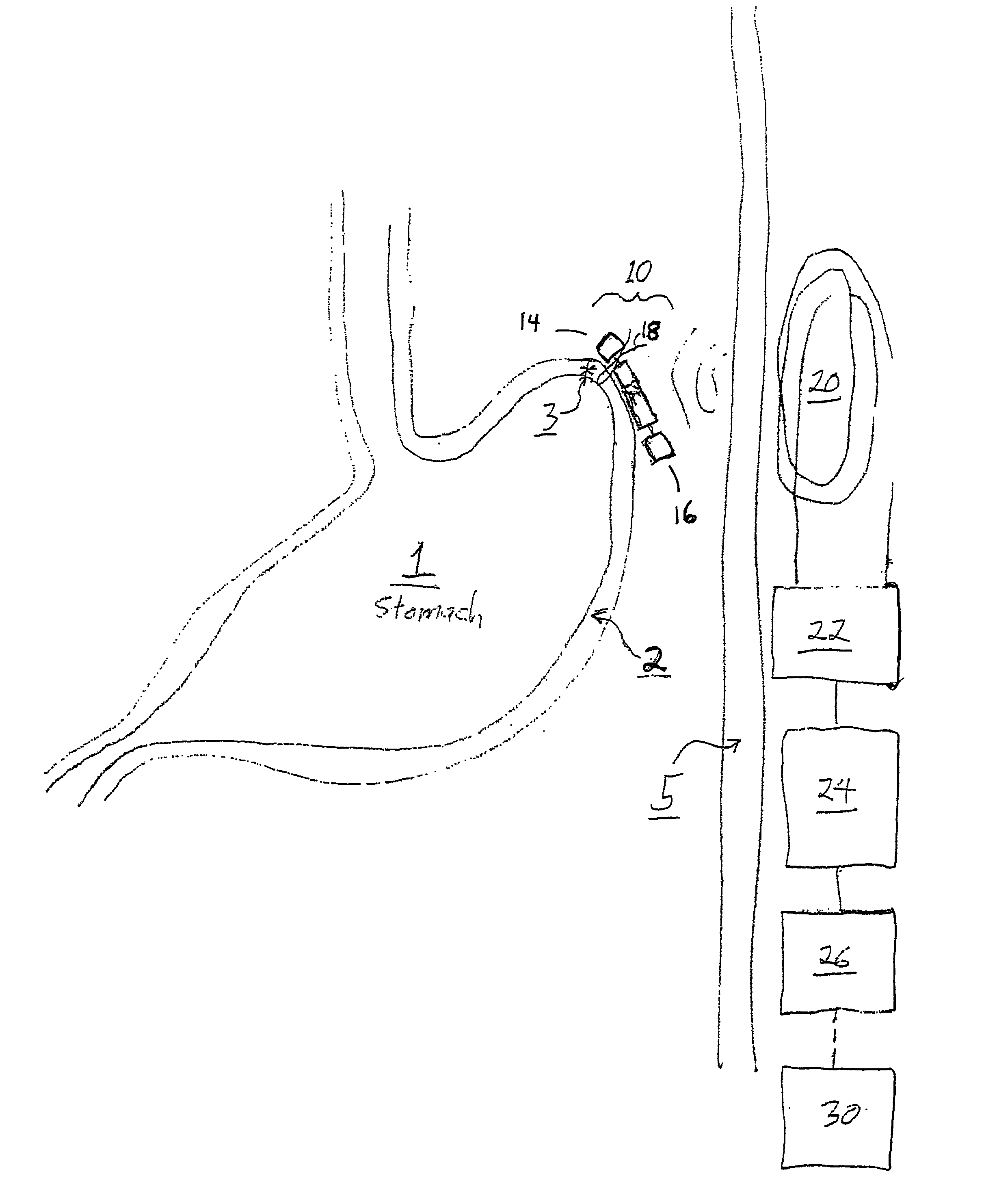 Method and apparatus to treat disorders of gastrointestinal peristalsis