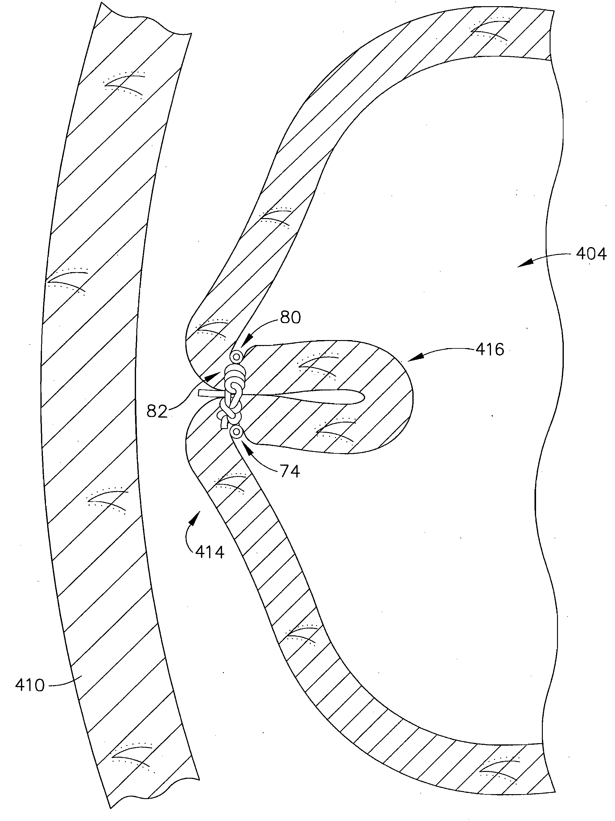 Disposable cartridge for use in a gastric volume reduction procedure