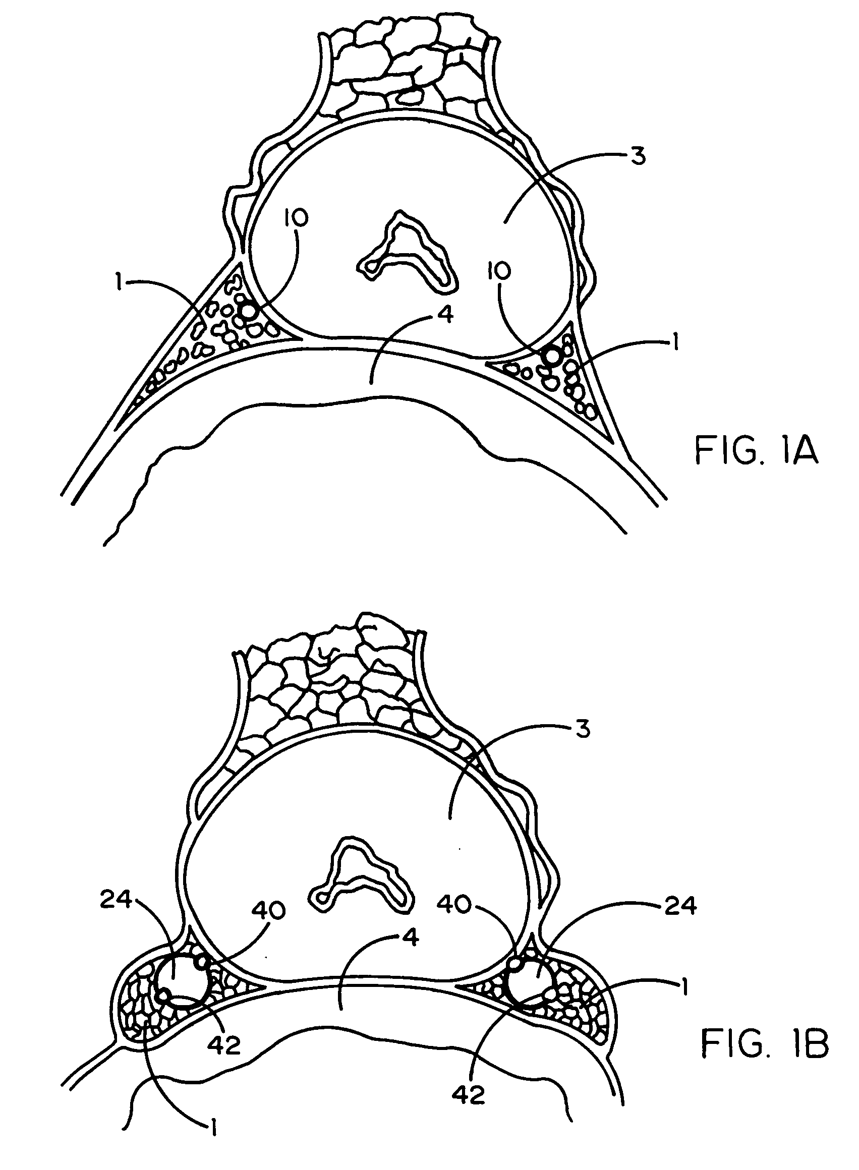 Tissue protective system and method for thermoablative therapies