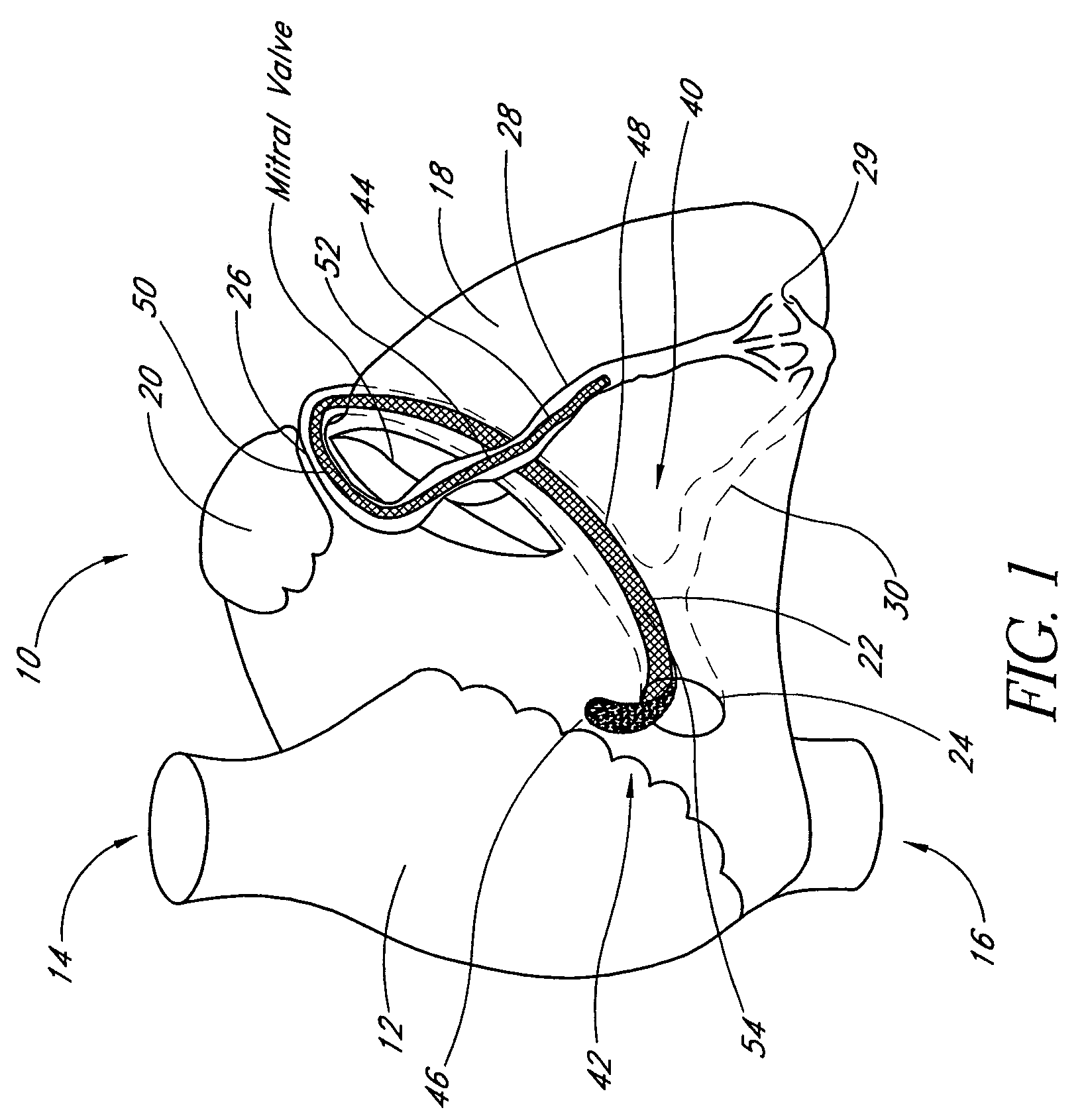Transluminal mitral annuloplasty with active anchoring