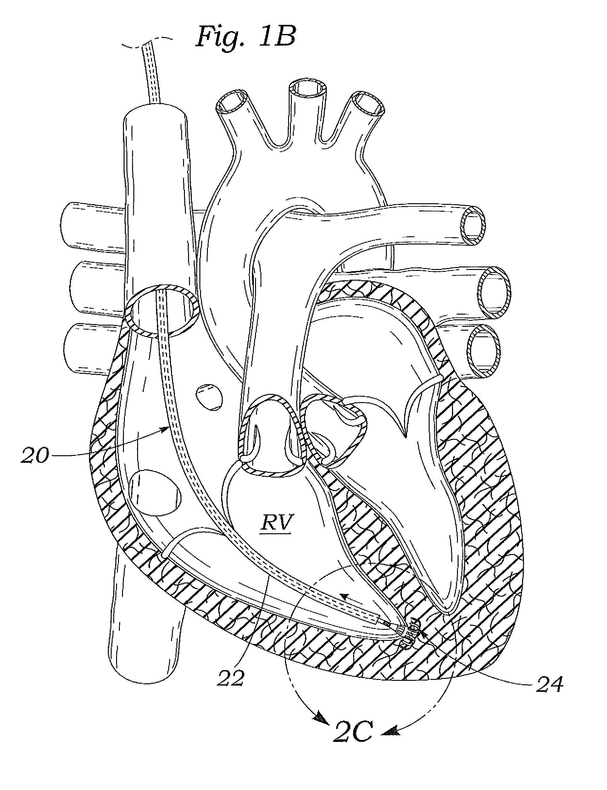 Systems and methods for placing a coapting member between valvular leaflets