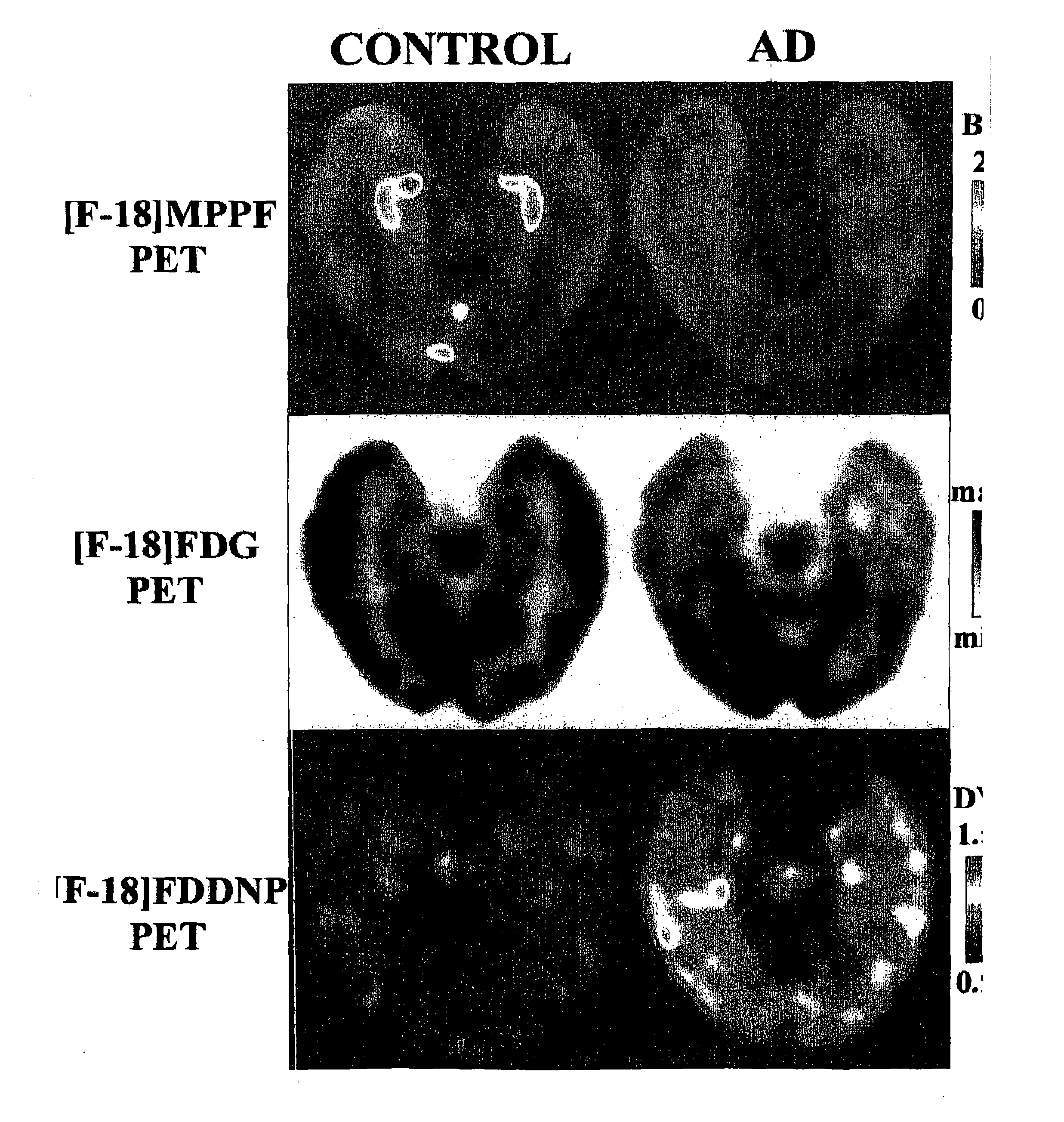 Method for Detecting Alzheimer's Disease and other Forms of Dementia, and Measuring Their Progression