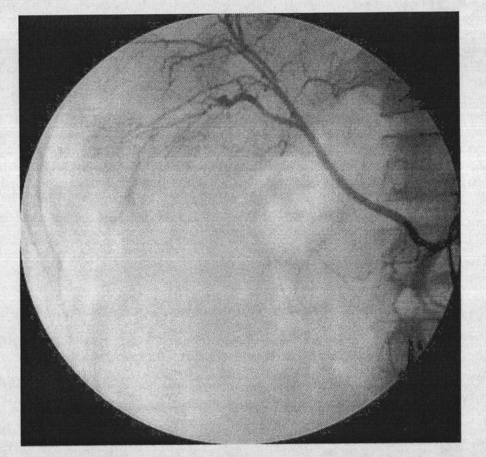 Software realization method of digital subtraction angiography