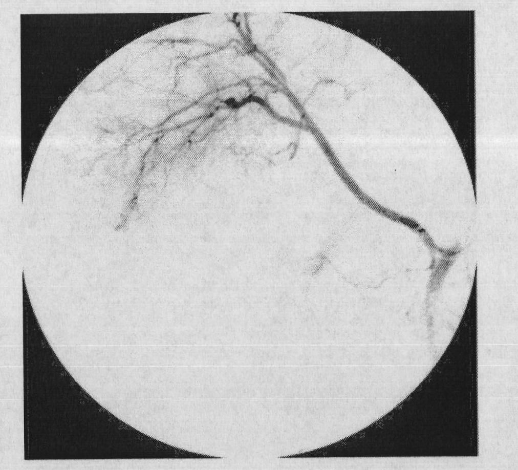 Software realization method of digital subtraction angiography