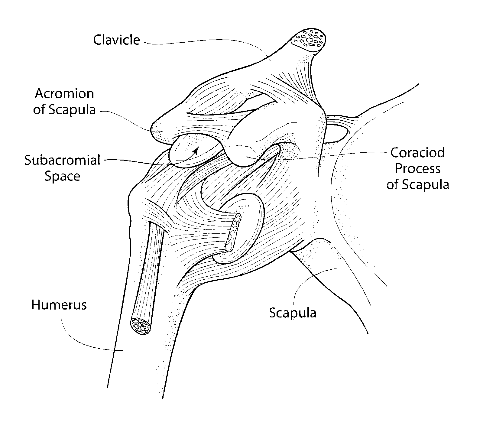 System and method for treating shoulder pain related to subacromial impingement syndrome