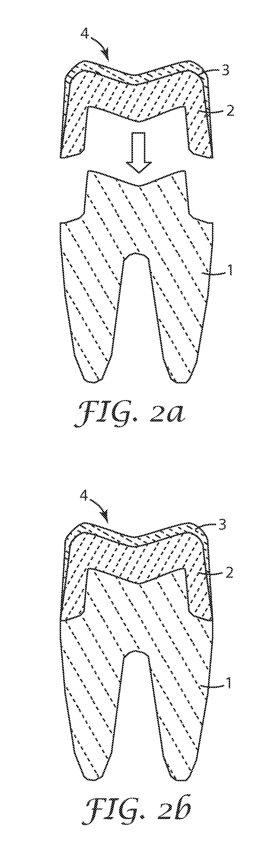 Method of producing a dental restoration, dental restoration and use thereof