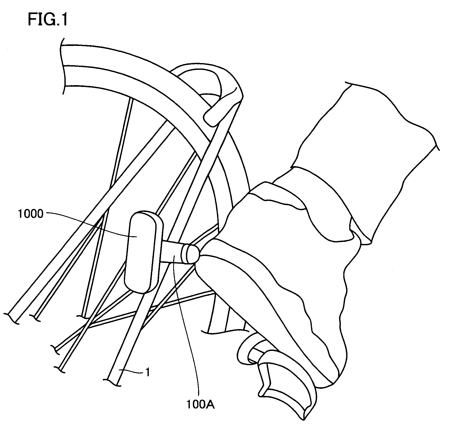 Fixing device