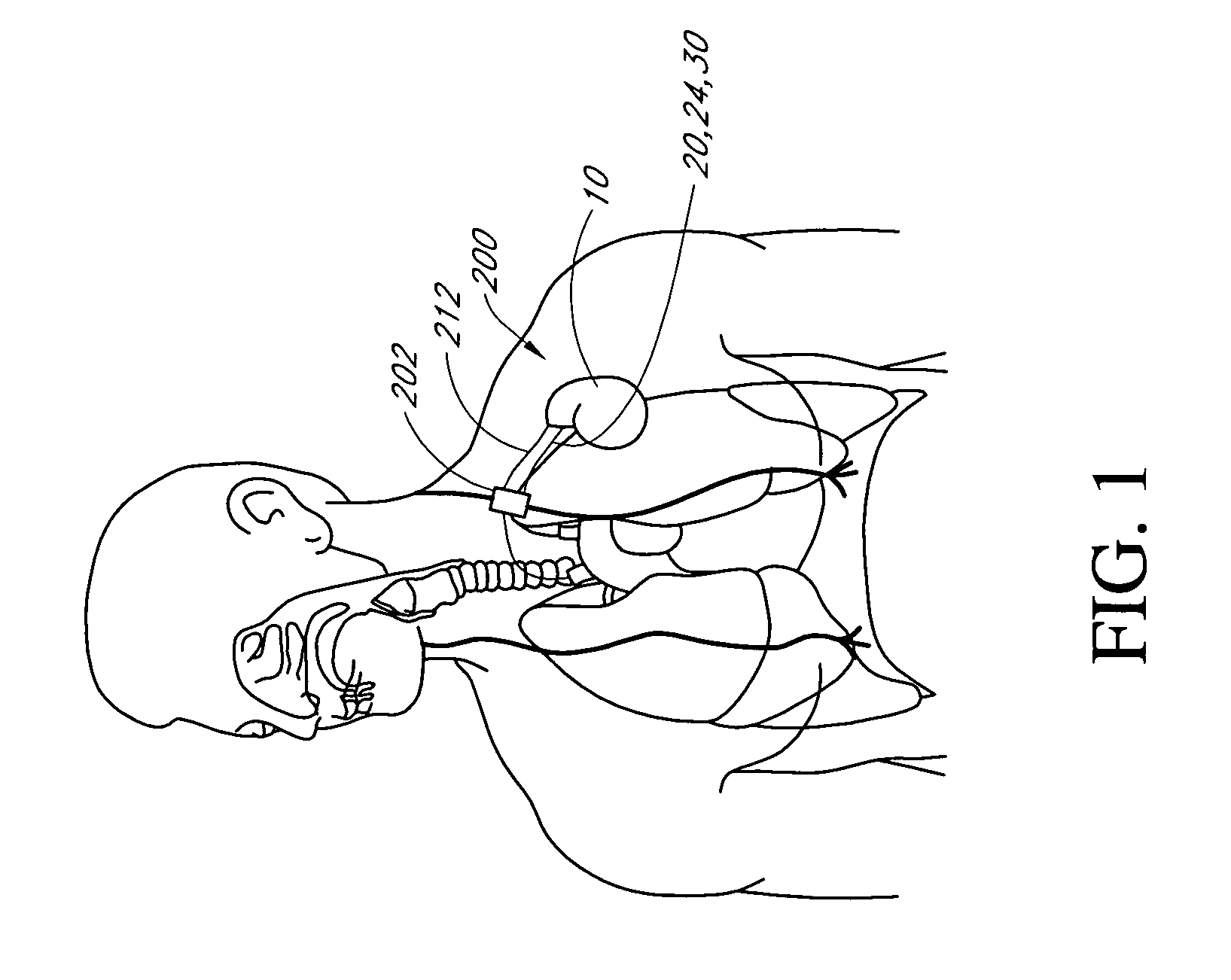 Implantable medical device with nerve signal sensing