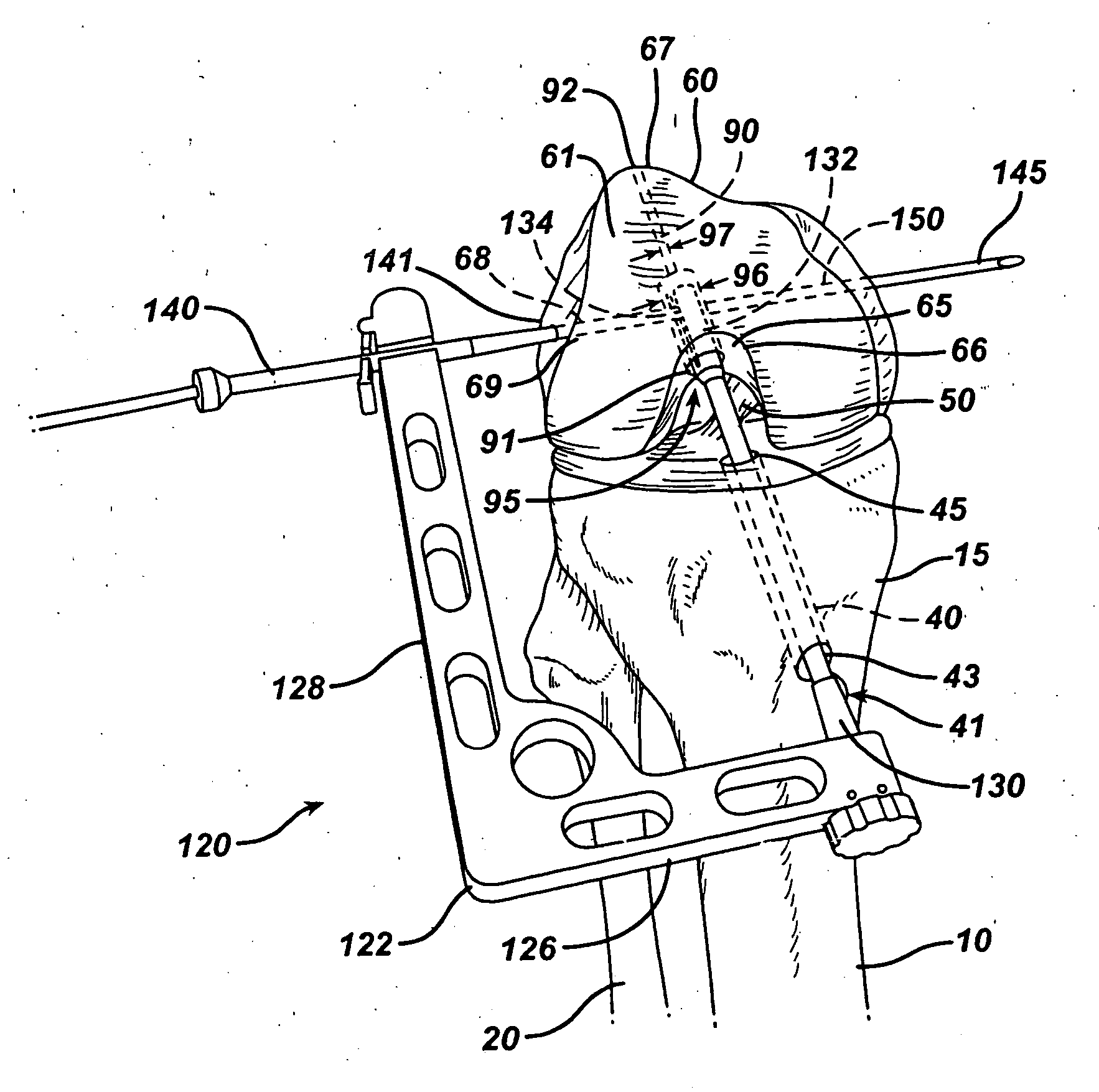 Method of replacing an anterior cruciate ligament in the knee