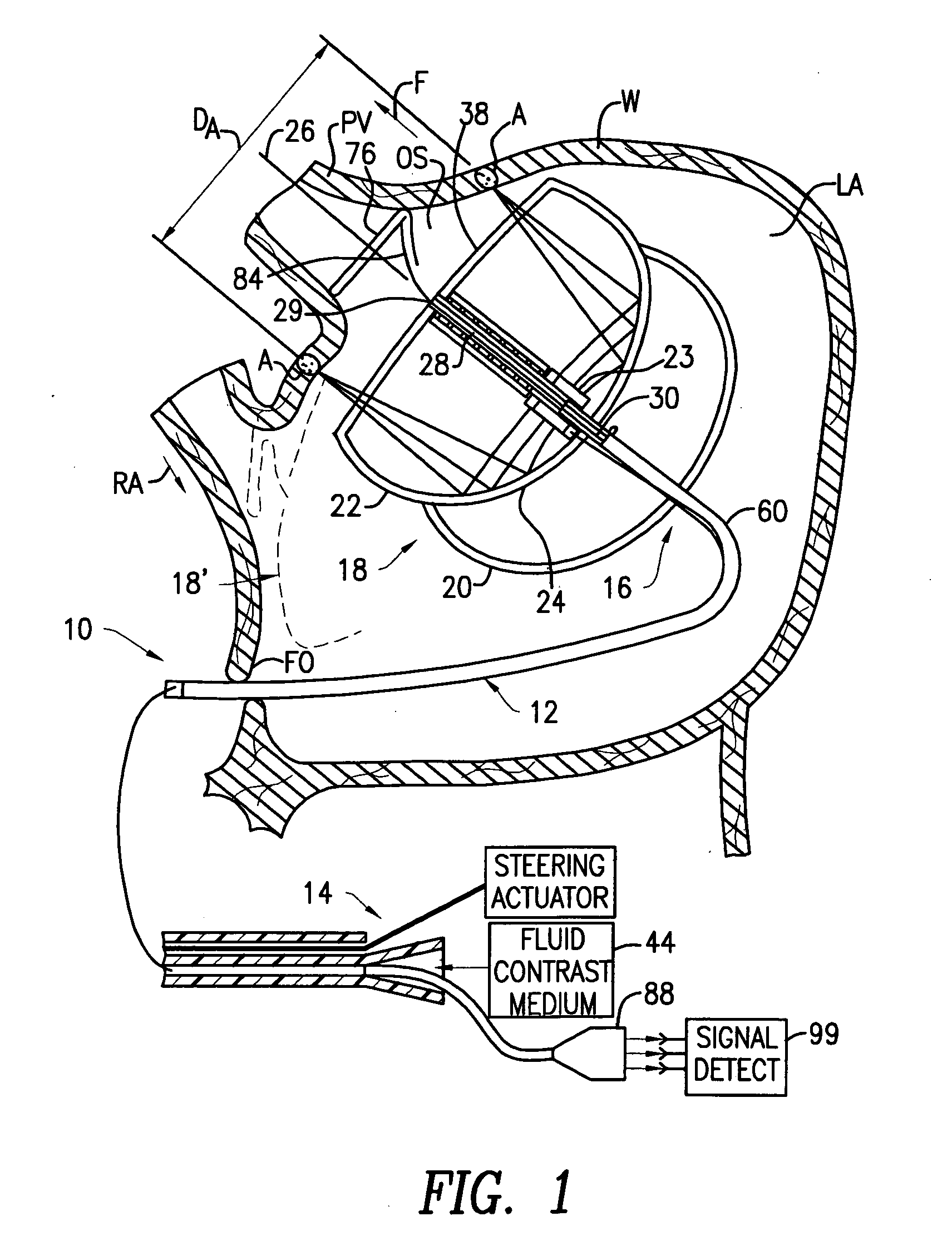 Miniature circular mapping catheter