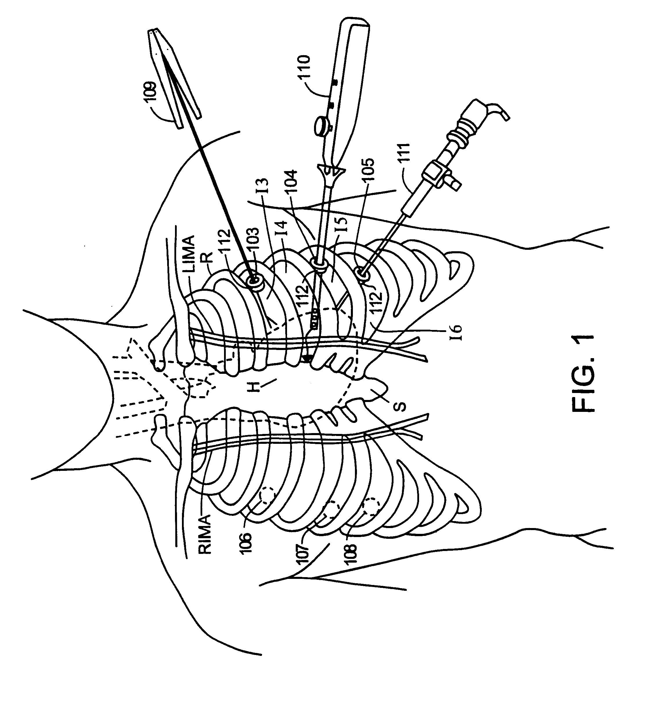 Devices and methods for port-access multivessel coronary artery bypass surgery