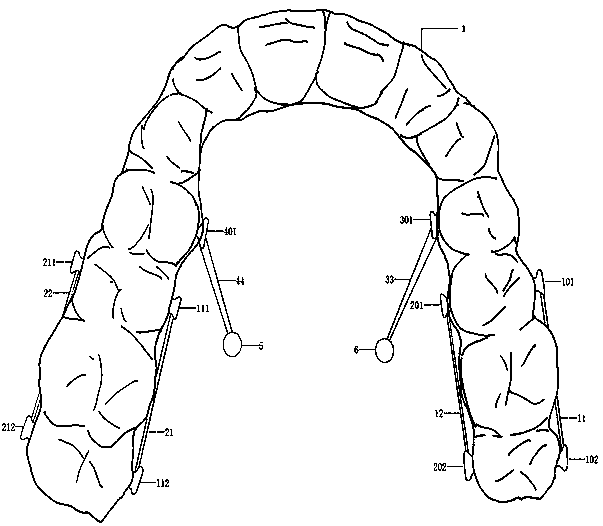 Invisible orthodontic appliance with energy storage elements and used for class II malocclusion