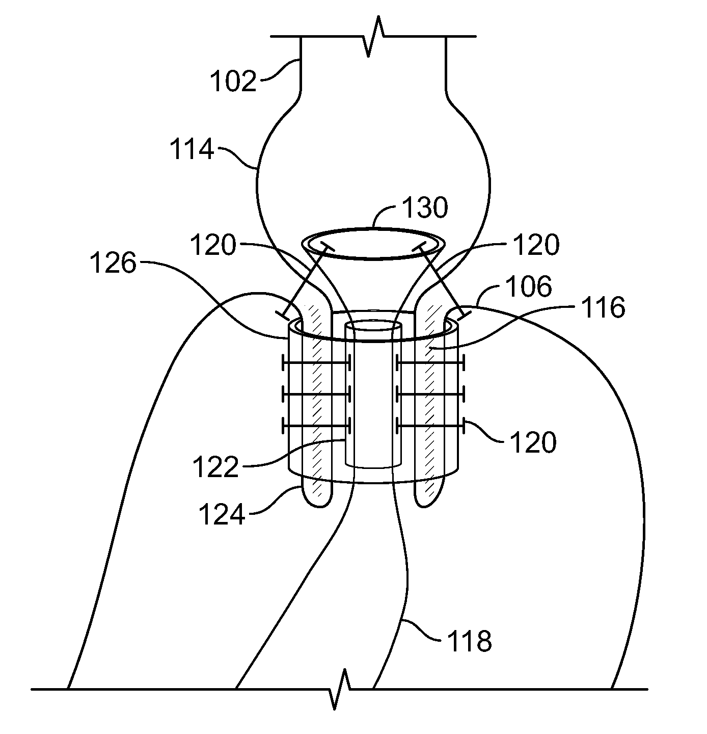 Devices and methods to deliver, retain and remove a separating device in an intussuscepted hollow organ