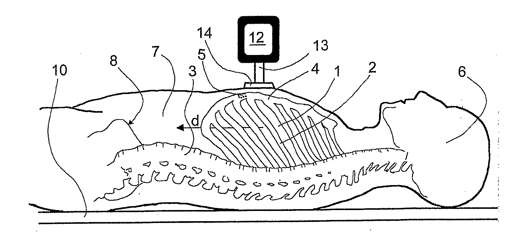  method and a device for abdominally stabilizing patient