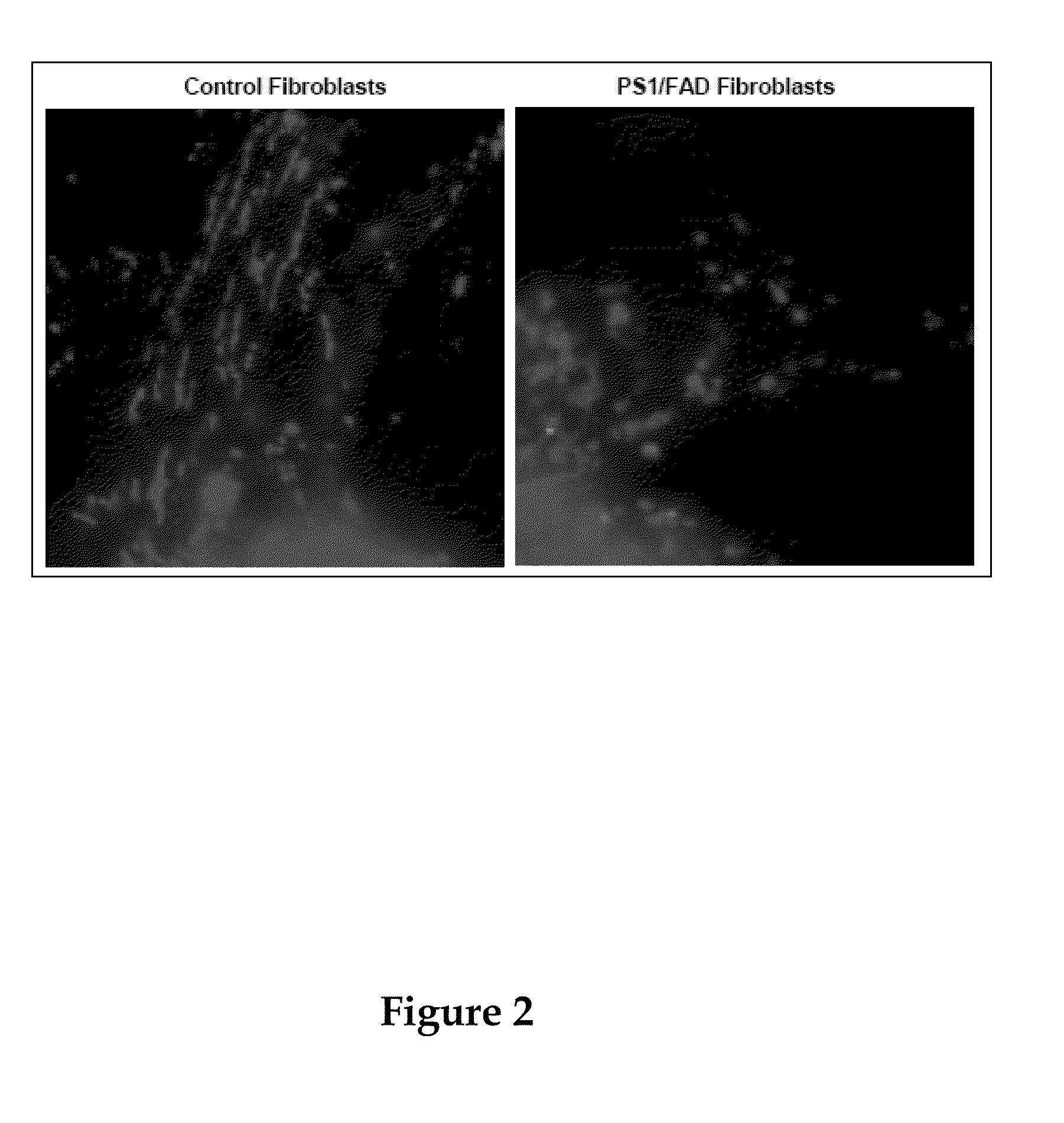 Methods for diagnosis and treatment of neurodegenerative diseases or disorders