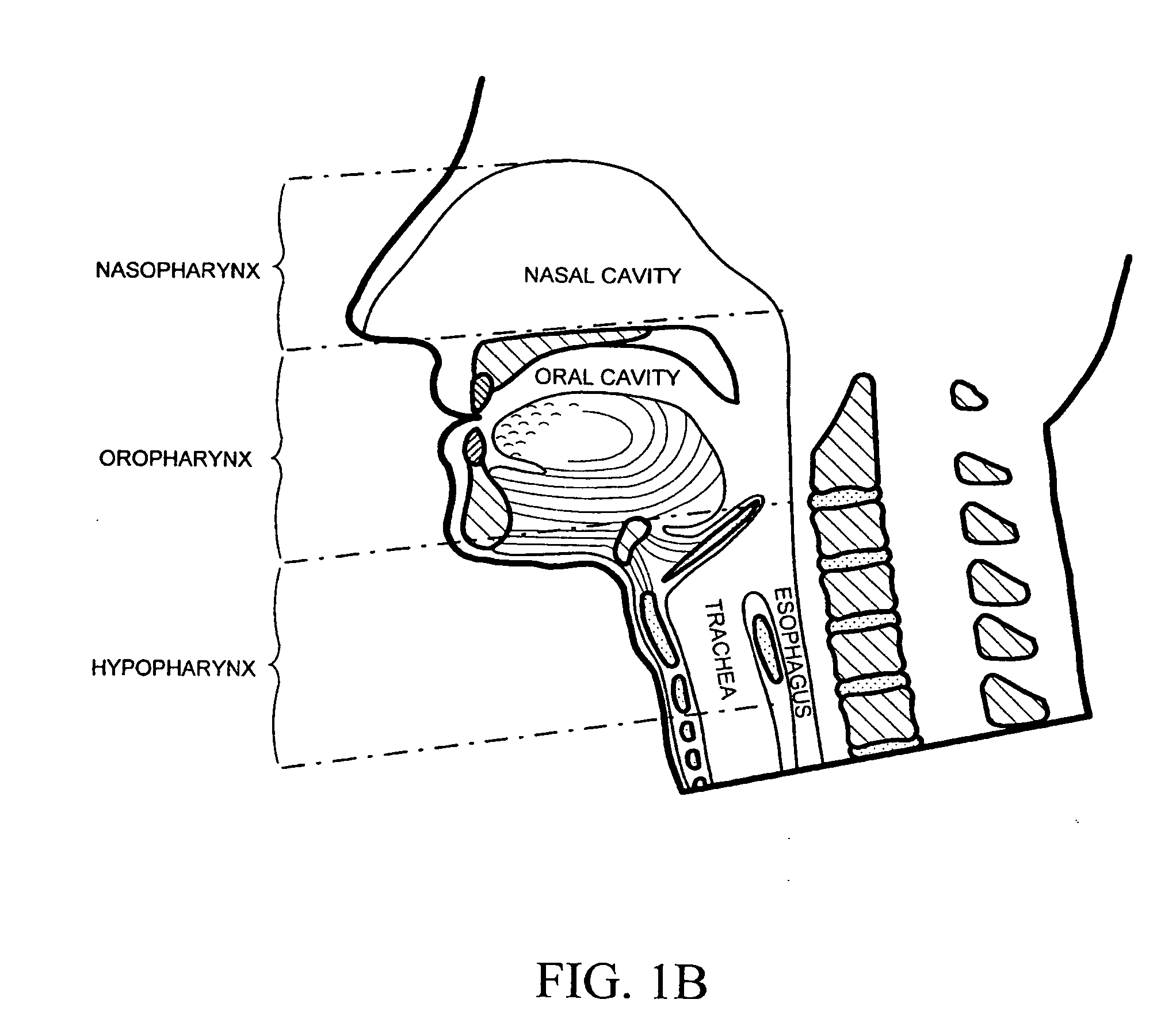 Devices and methods for treating sleep disorders