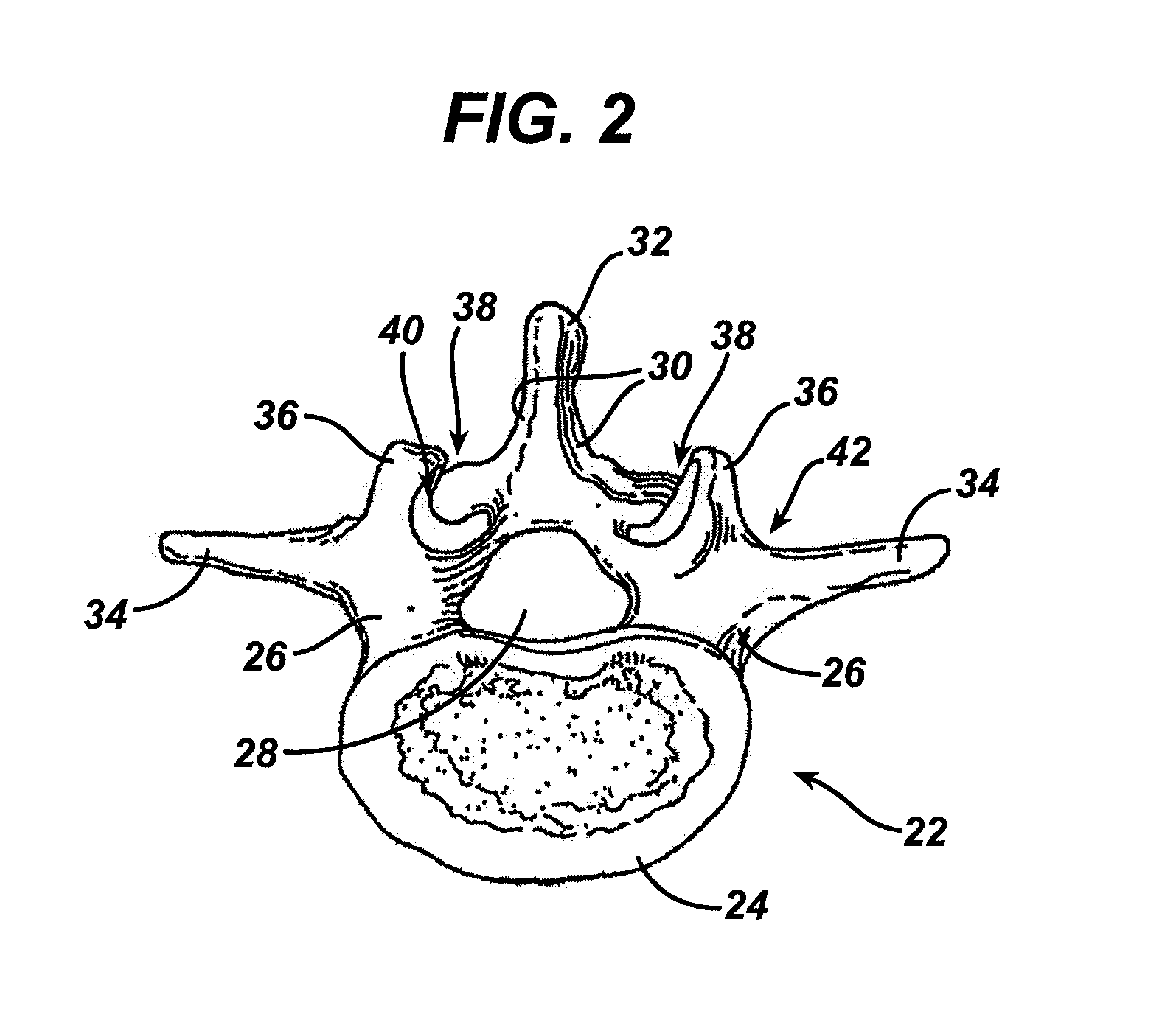 Intra-facet fixation device and method of use