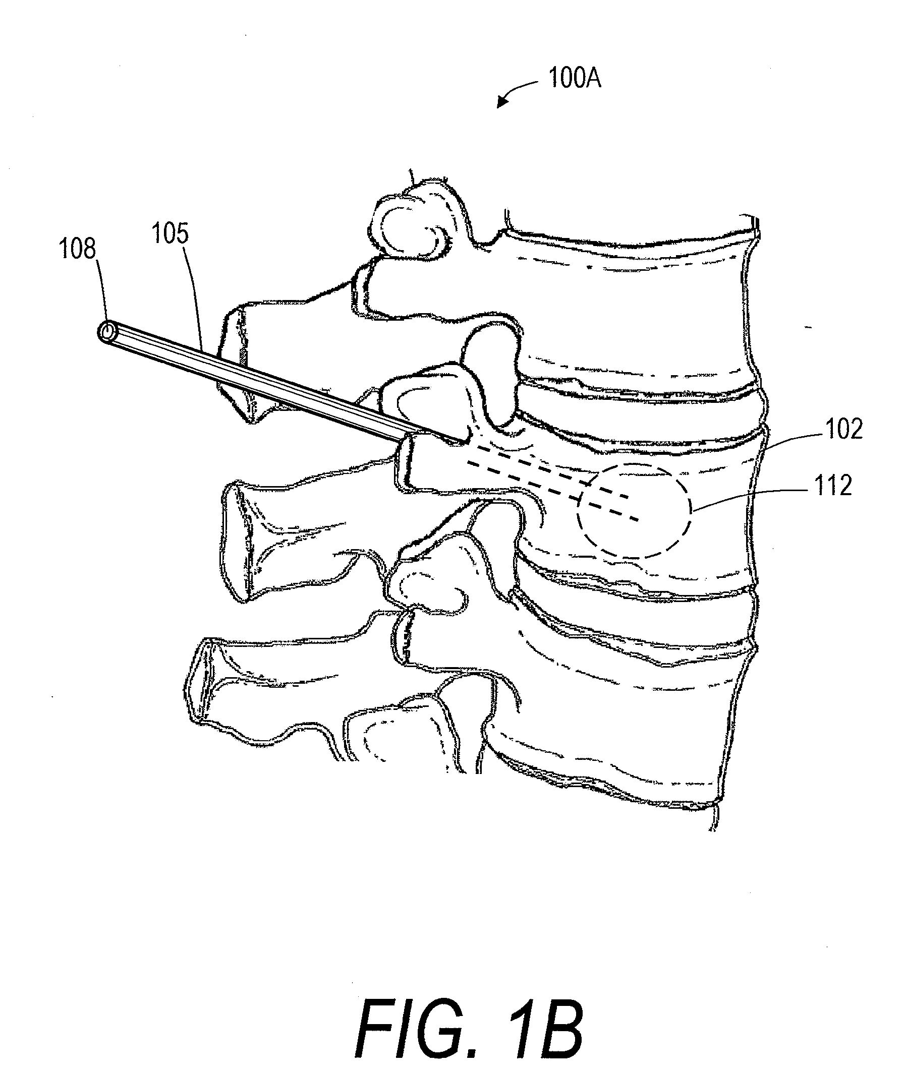 Systems for treating bone