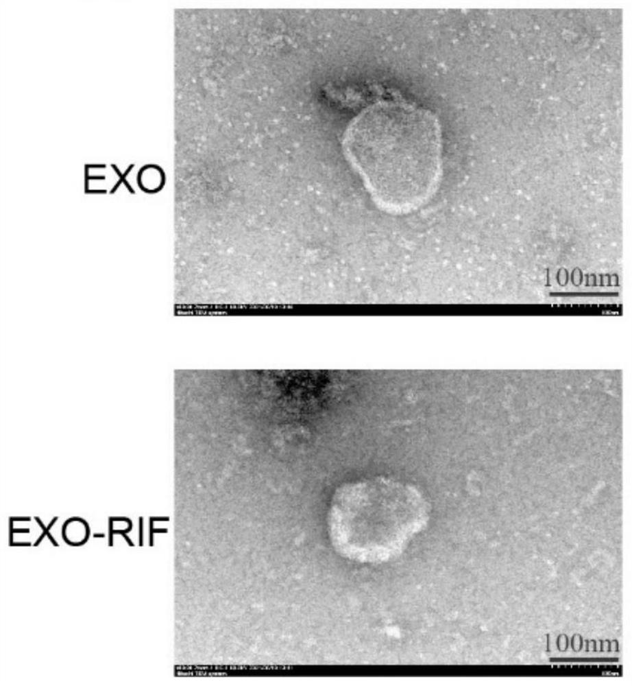 Exosome compound with tumor inhibition effect