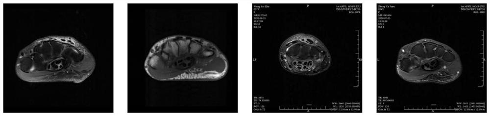 Carpal canal image segmentation method and system based on neural network