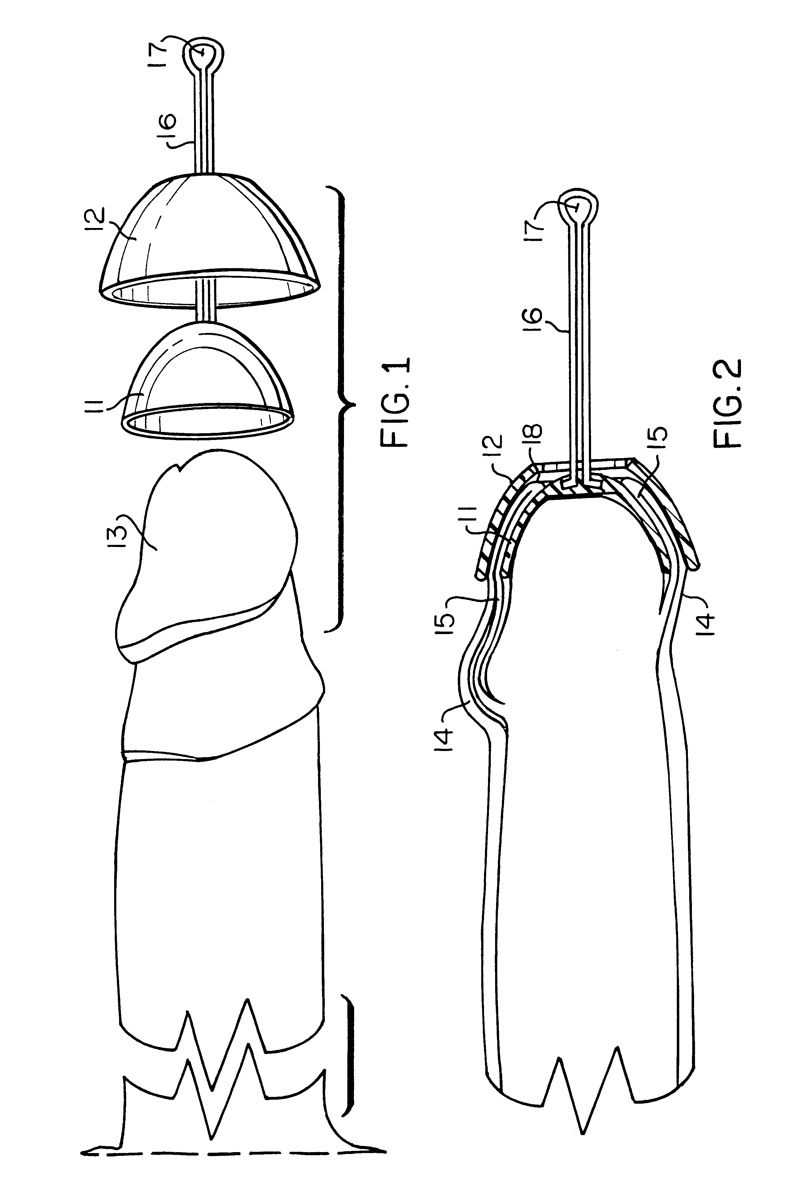 Foreskin restoration device