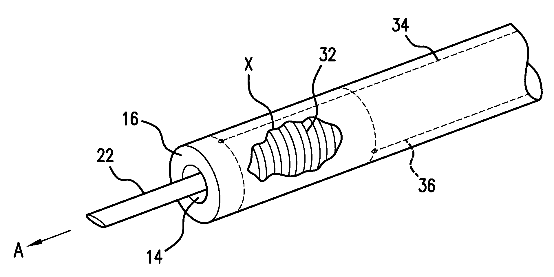 Therapeutic catheter with displacement sensing transducer