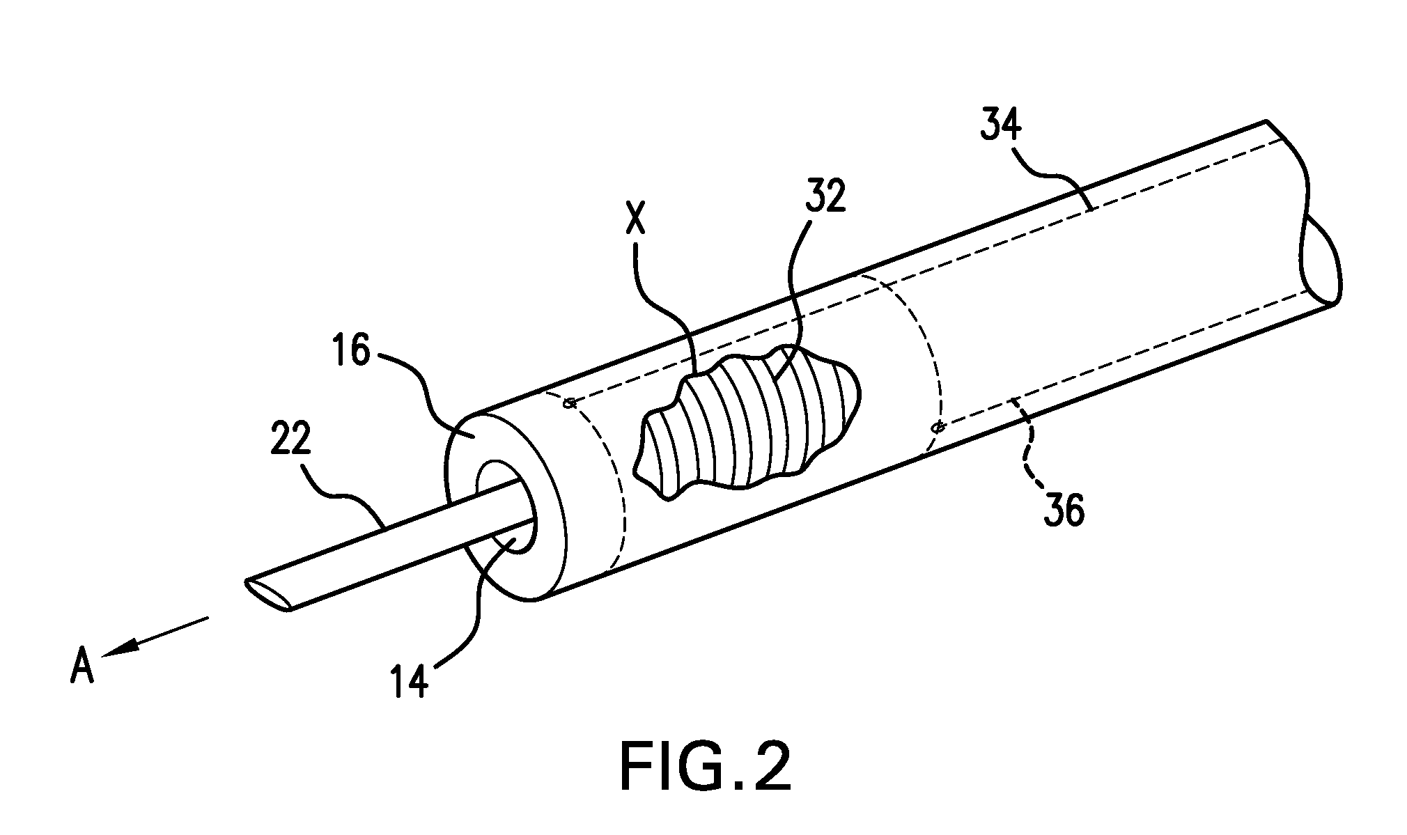 Therapeutic catheter with displacement sensing transducer