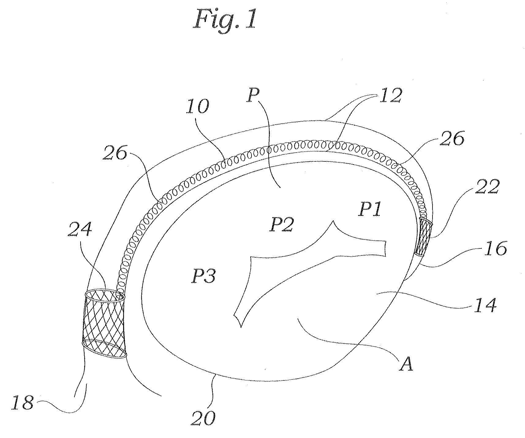Coiled implant for mitral valve repair