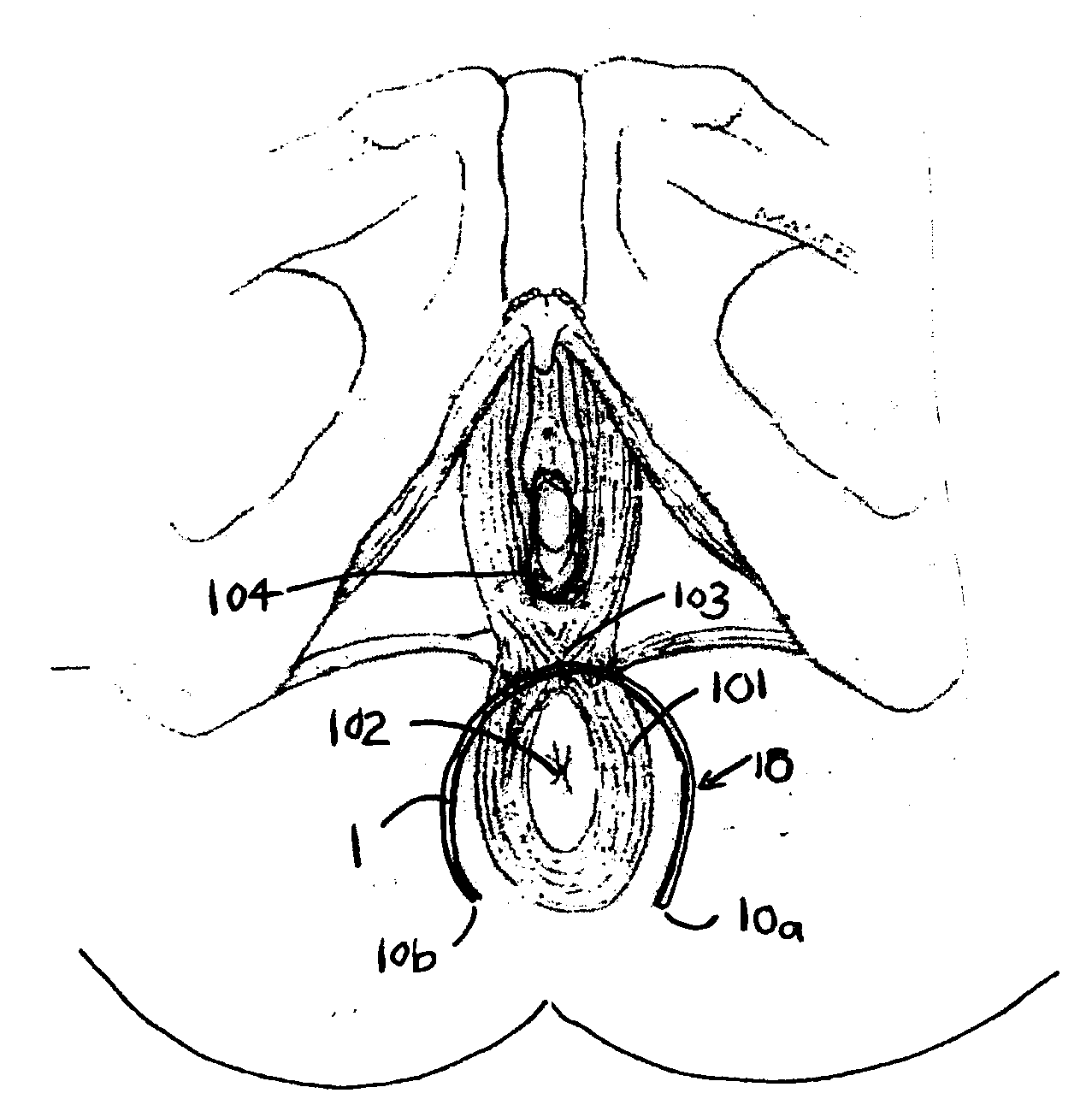 Method of treating anal incontinence