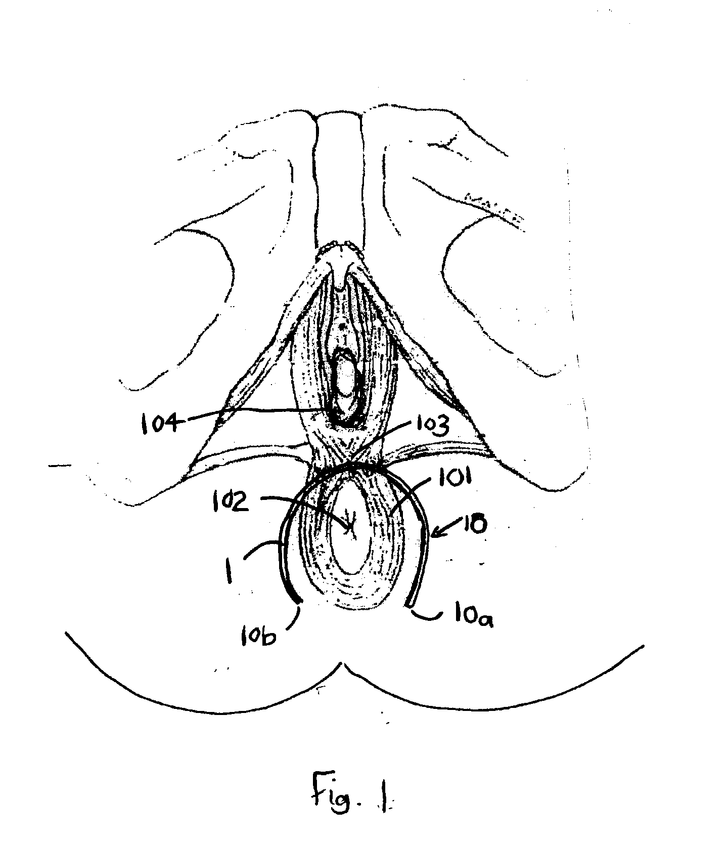 Method of treating anal incontinence