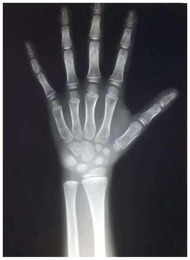 Method and related equipment for determining the developmental grade of carpal bones of the hand