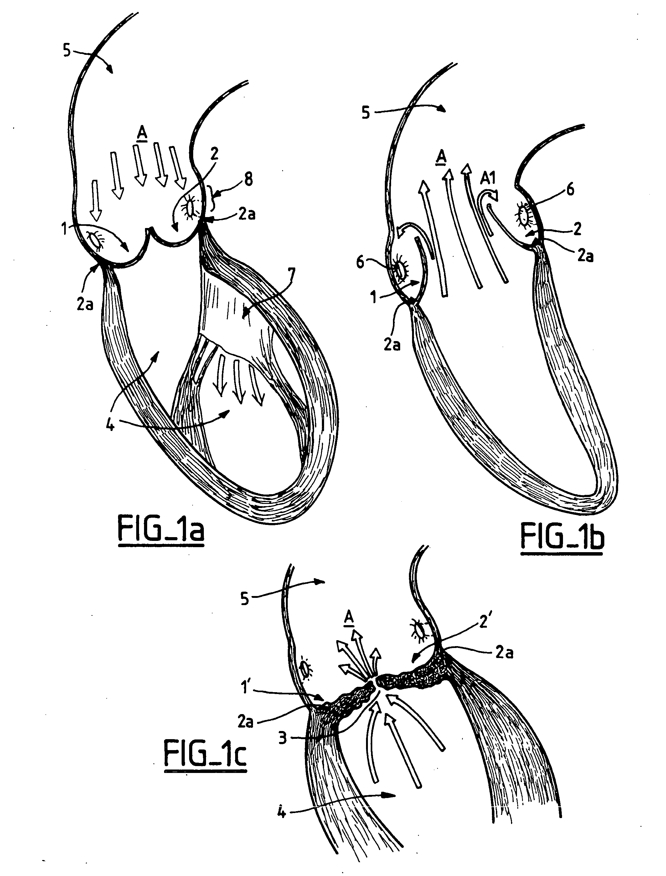 Valve prosthesis for implantation in body channels