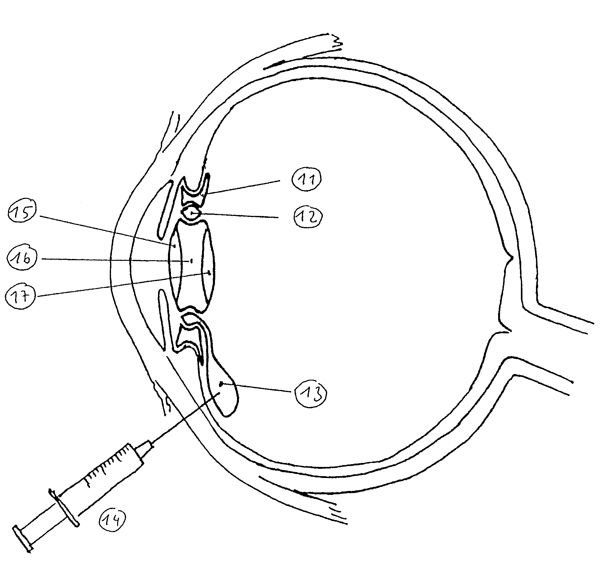 Accommodative lens implant, controlled by the ciliary muscle