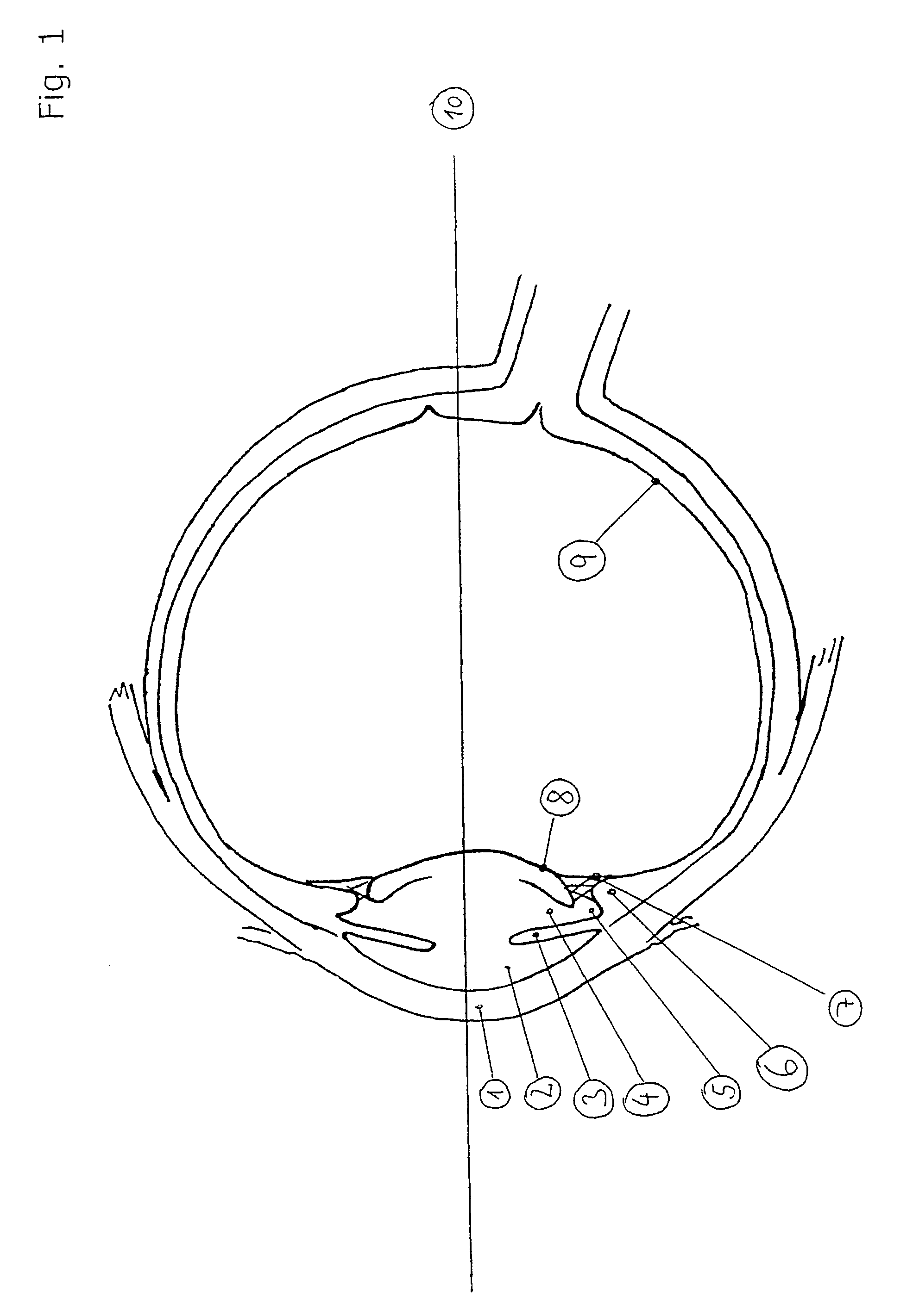 Accommodative lens implant, controlled by the ciliary muscle
