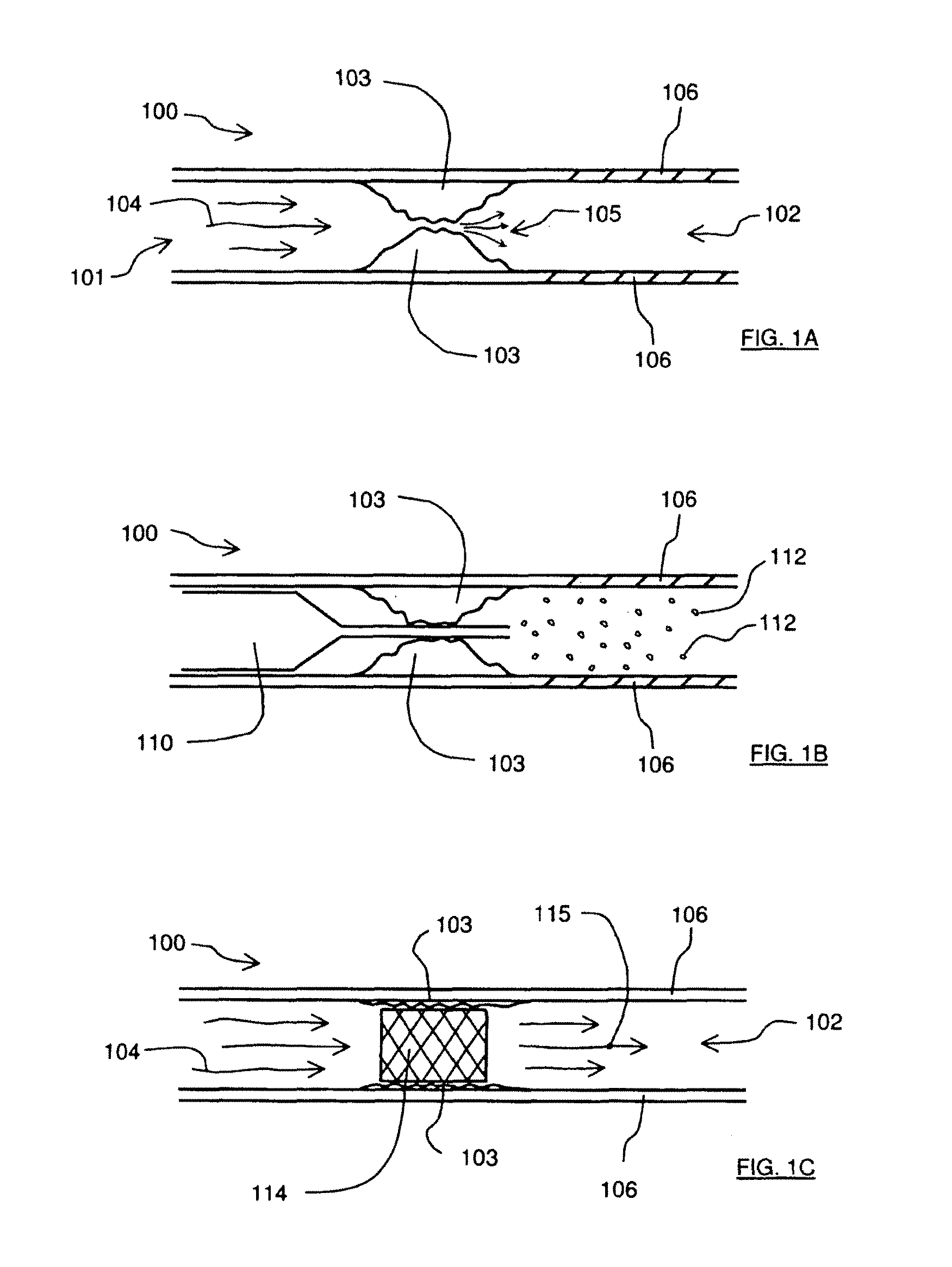 Apparatus to prevent reperfusion injury