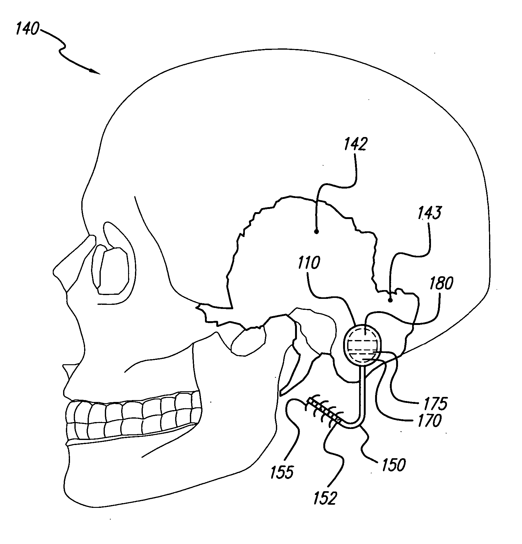 Skull-mounted electrical stimulation system