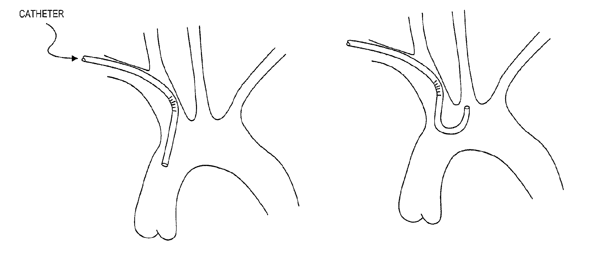 Method of accessing the left common carotid artery