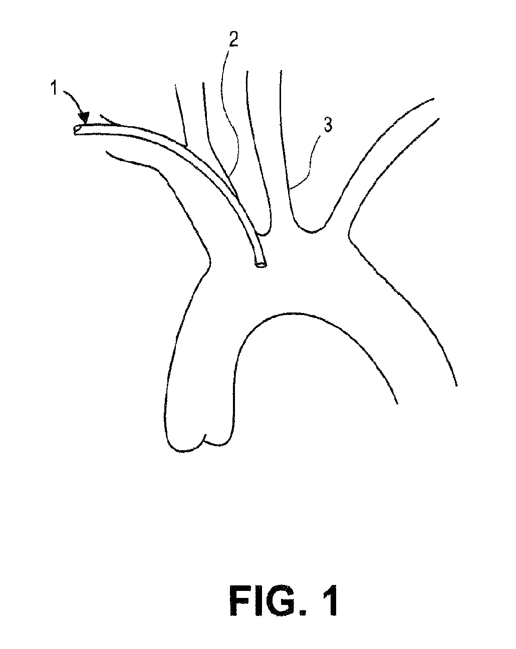 Method of accessing the left common carotid artery