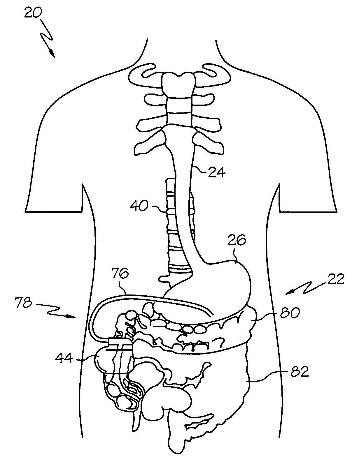 Gastroelectric stimulation for influencing pancreatic secretions