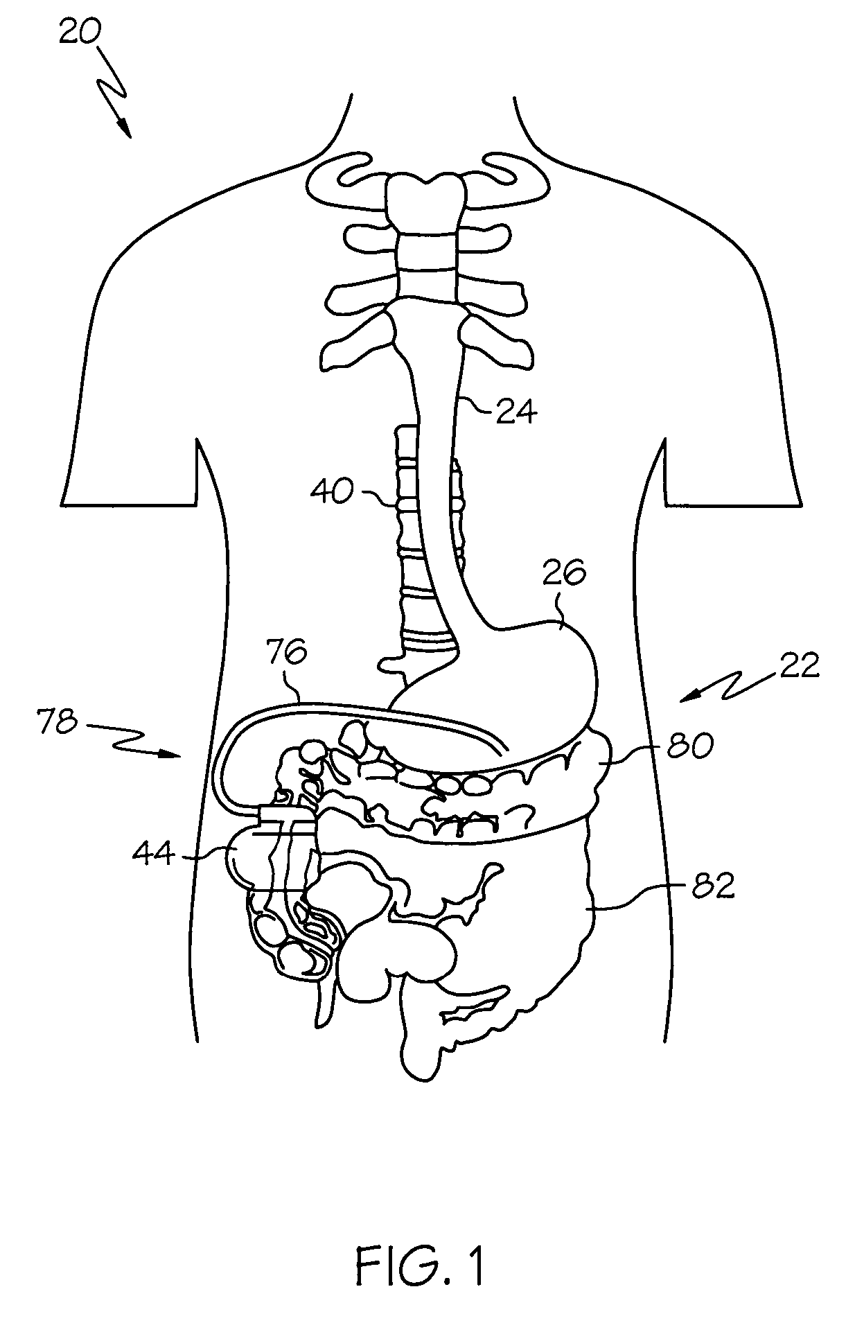 Gastroelectric stimulation for influencing pancreatic secretions