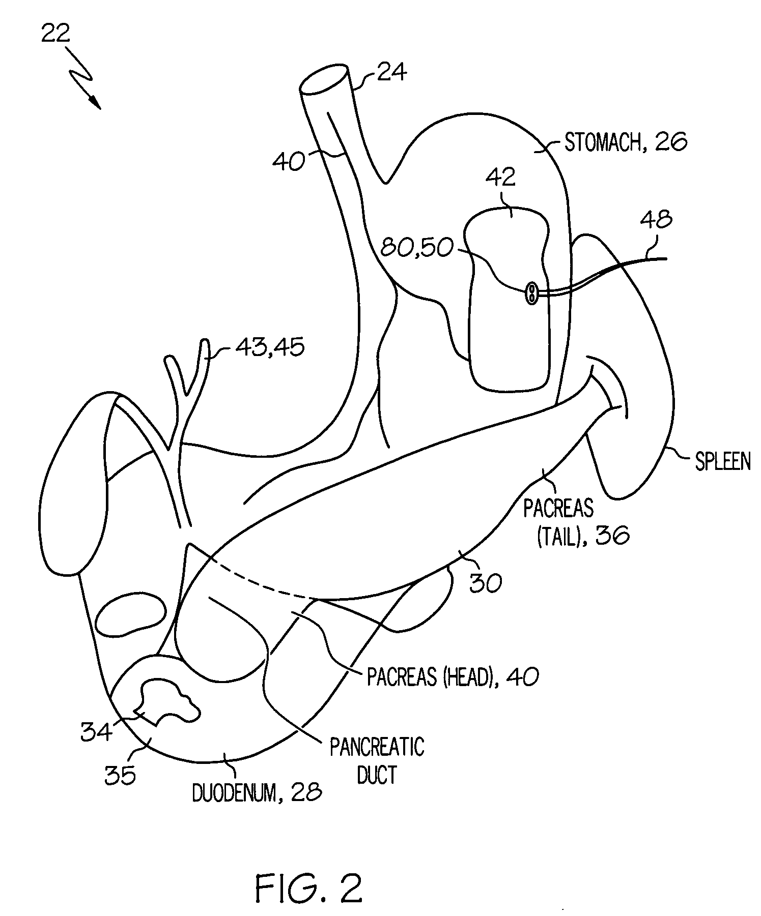 Gastroelectric stimulation for influencing pancreatic secretions