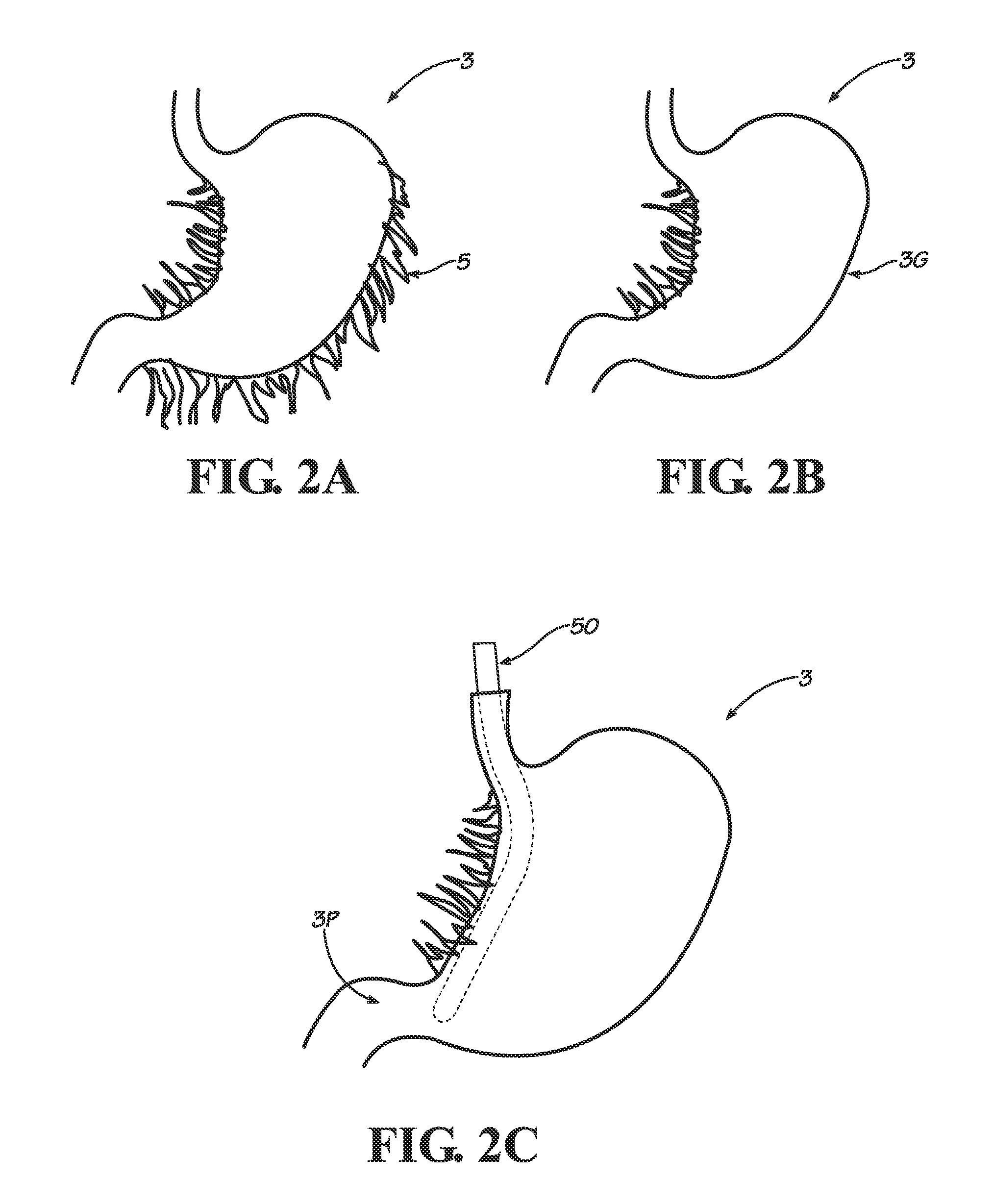 Methods, instruments and devices for extragastric reduction of stomach volume