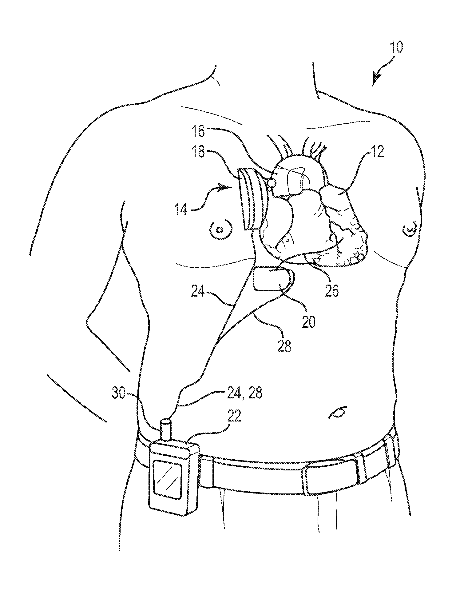 Combination heart assist systems, methods, and devices