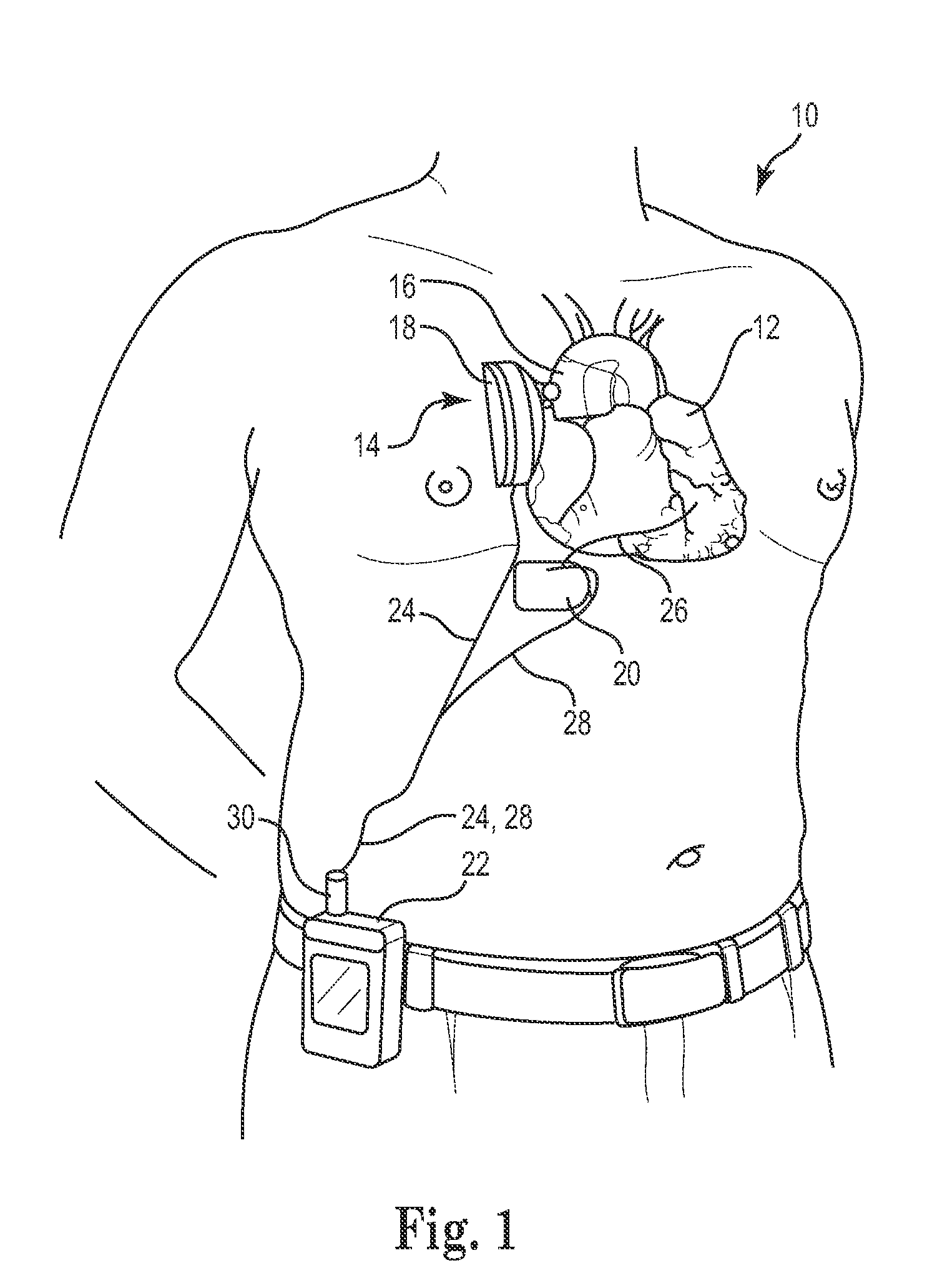 Combination heart assist systems, methods, and devices