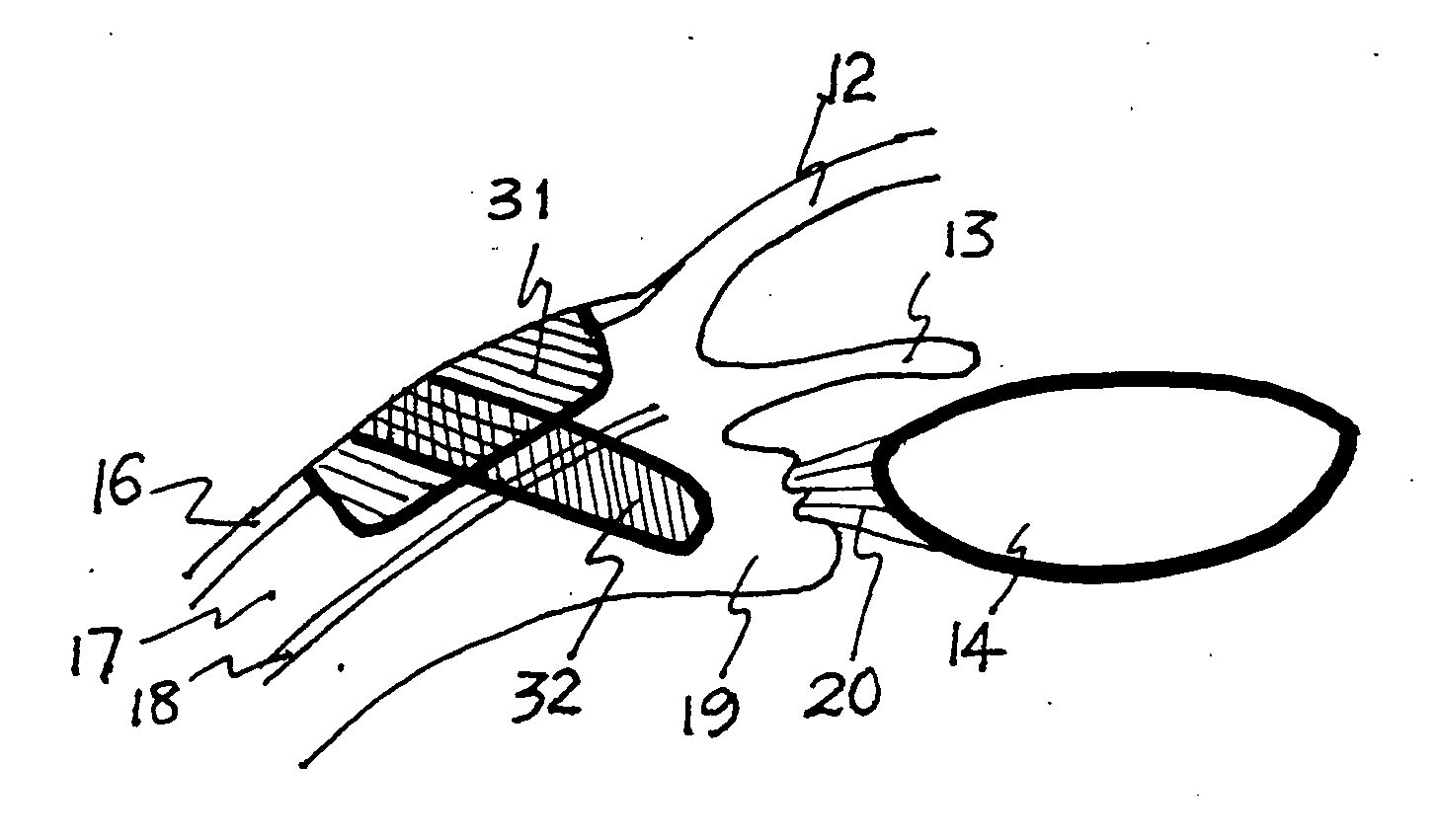 Method and apparatus for the treatment of presbyopia and glaucoma by ciliary body ablation